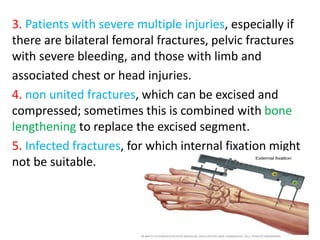 3. Patients with severe multiple injuries, especially if
there are bilateral femoral fractures, pelvic fractures
with severe bleeding, and those with limb and
associated chest or head injuries.
4. non united fractures, which can be excised and
compressed; sometimes this is combined with bone
lengthening to replace the excised segment.
5. Infected fractures, for which internal fixation might
not be suitable.
 