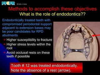 Tooth Lrpd Introduction and basic components of rpd's copy | PPT
