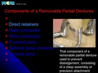 Retainer In Rpd Introduction and basic components of rpd's copy | PPT