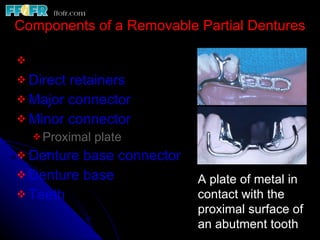 Retainer In Rpd Introduction and basic components of rpd's copy | PPT
