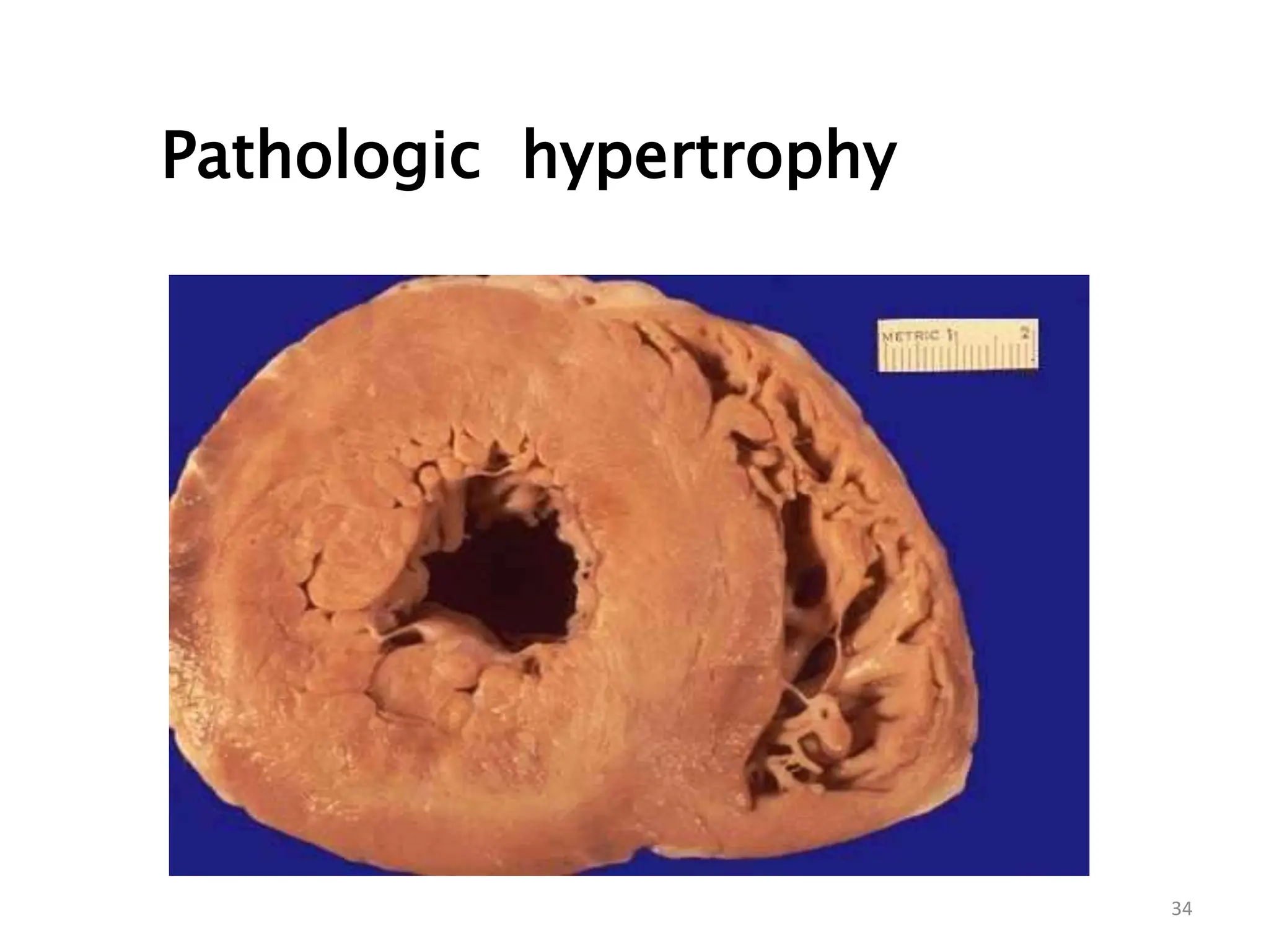 Pathological Hypertrophy
Pathologic hypertrophy
34
 