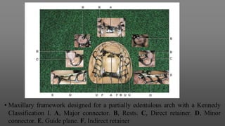 • Maxillary framework designed for a partially edentulous arch with a Kennedy
Classification I. A, Major connector. B, Rests. C, Direct retainer. D, Minor
connector. E, Guide plane. F, Indirect retainer
 
