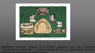 • Mandibular framework designed for a partially edentulous arch with a Kennedy
Classification II, modification 1. A, Major connector. B, Rests. C, Direct retainer. D, Minor
connector. E, Guide plane. F, Indirect retainer.
 