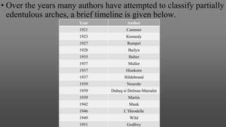 • Over the years many authors have attempted to classify partially
edentulous arches, a brief timeline is given below.
Year Author
1921 Cummer
1923 Kennedy
1927 Rumpel
1928 Bailyn
1935 Balter
1937 Muller
1937 Hisekorn
1937 Hildebrand
1939 Neurohr
1939 Dubeq si Delmas-Marsalet
1939 Martin
1942 Mauk
1946 L’Hirodelle
1949 Wild
1951 Godfrey
 