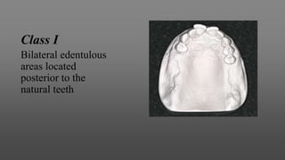 Class I
Bilateral edentulous
areas located
posterior to the
natural teeth
 
