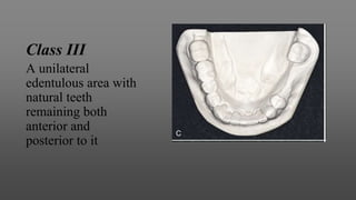Class III
A unilateral
edentulous area with
natural teeth
remaining both
anterior and
posterior to it
 
