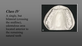 Class IV
A single, but
bilateral (crossing
the midline),
edentulous area
located anterior to
the remaining
natural teeth
 