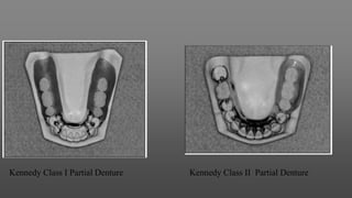Kennedy Class I Partial Denture Kennedy Class II Partial Denture
 