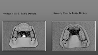 Kennedy Class III Partial Denture Kennedy Class IV Partial Denture
 