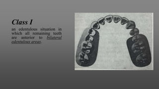 Class I
an edentulous situation in
which all remaining teeth
are anterior to bilateral
edentulous areas.
 