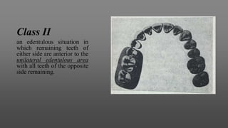 Class II
an edentulous situation in
which remaining teeth of
either side are anterior to the
unilateral edentulous area
with all teeth of the opposite
side remaining.
 