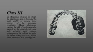 Class III
an edentulous situation in which
the edentulous area is bounded by
teeth unable to assume total
support of the necessary
prosthesis. These abutments
require the aid of teeth remotely
located, so the principles of cross
arch splinting (and counter
leverage) can be utilised to resist
the lateral tilting forces to which
these abutments will be subjected.
 