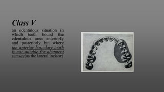 Class V
an edentulous situation in
which teeth bound the
edentulous area anteriorly
and posteriorly but where
the anterior boundary tooth
is not suitable for abutment
service(as the lateral incisor)
 