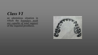Class VI
an edentulous situation in
which the boundary teeth
are capable of total support
of the required prosthesis.
 