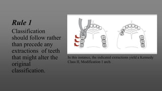 Rule 1
Classification
should follow rather
than precede any
extractions of teeth
that might alter the
original
classification.
In this instance, the indicated extractions yield a Kennedy
Class II, Modification 1 arch.
 