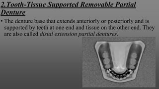 2.Tooth-Tissue Supported Removable Partial
Denture
• The denture base that extends anteriorly or posteriorly and is
supported by teeth at one end and tissue on the other end. They
are also called distal extension partial dentures.
 