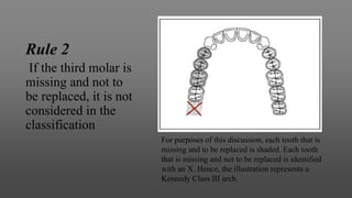 Rule 2
If the third molar is
missing and not to
be replaced, it is not
considered in the
classification
For purposes of this discussion, each tooth that is
missing and to be replaced is shaded. Each tooth
that is missing and not to be replaced is identified
with an X. Hence, the illustration represents a
Kennedy Class III arch.
 