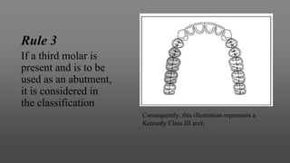 Rule 3
If a third molar is
present and is to be
used as an abutment,
it is considered in
the classification
Consequently, this illustration represents a
Kennedy Class III arch.
 