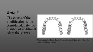 Rule 7
The extent of the
modification is not
considered, only the
number of additional
edentulous areas
Consequently, both illustrations represent Kennedy Class II,
Modification 1 arches.
 