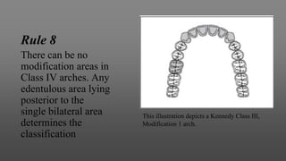 Rule 8
There can be no
modification areas in
Class IV arches. Any
edentulous area lying
posterior to the
single bilateral area
determines the
classification
This illustration depicts a Kennedy Class III,
Modification 1 arch.
 