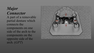 Major
Connector
A part of a removable
partial denture which
connects the
components on one
side of the arch to the
components on the
opposite side of the
arch. (GPT)
 