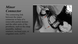 Minor
Connector
The connecting link
between the major
connector or base of a
removable partial denture
and the other units of the
prosthesis, such as the clasp
assembly, indirect
retainers, occlusal rests, or
cingulum rests. (GPT)
 