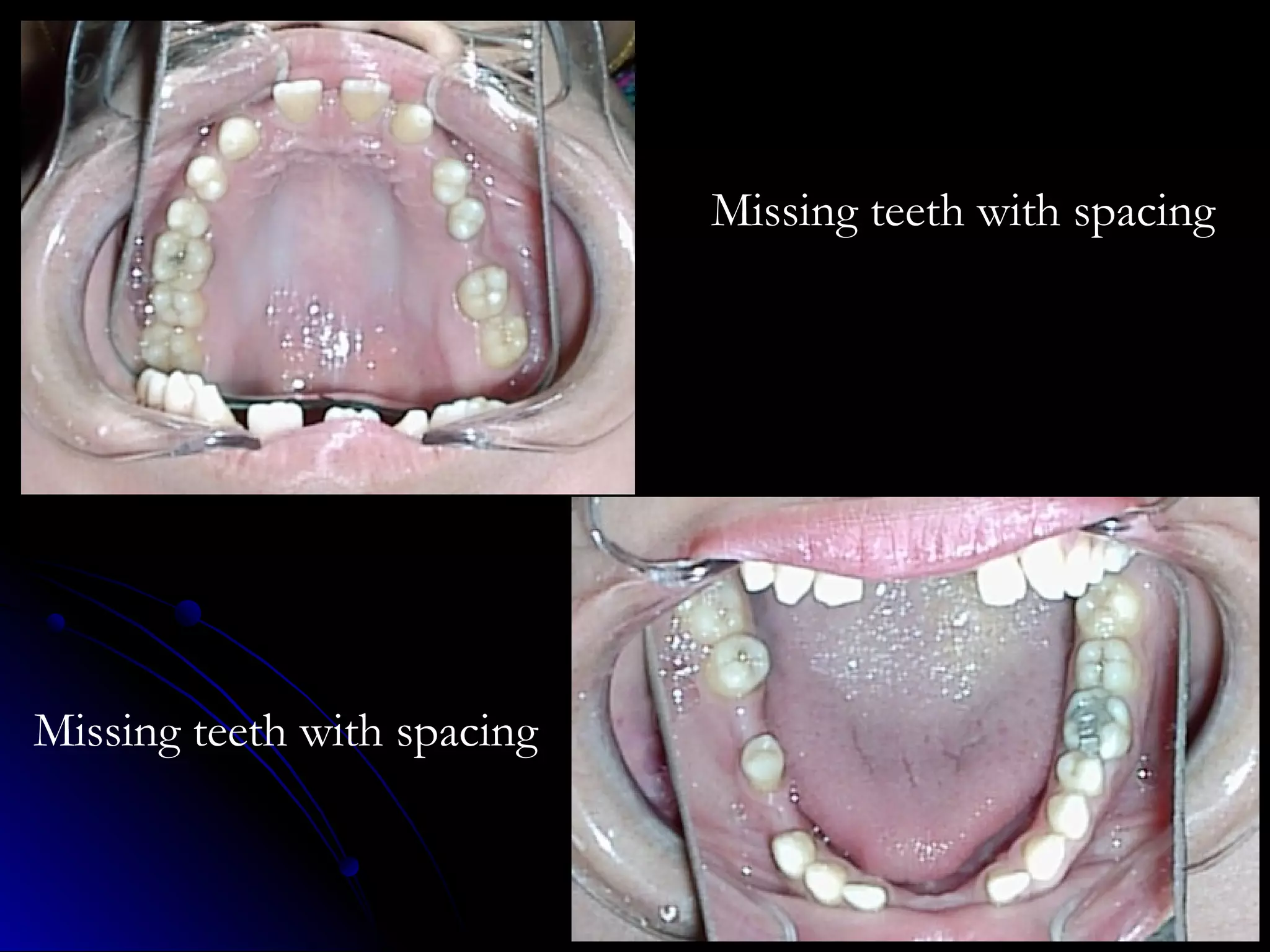 Missing teeth with spacing
Missing teeth with spacing
 