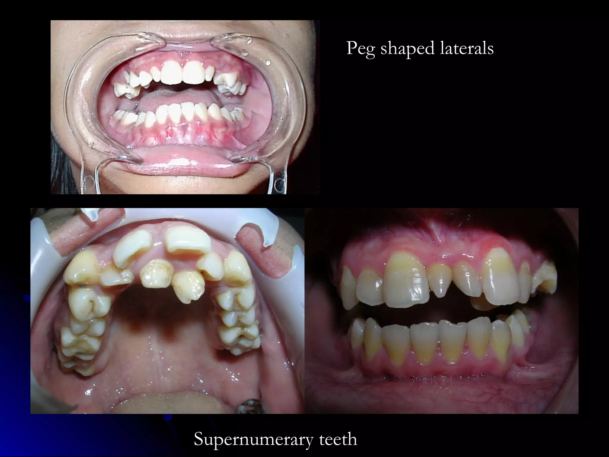 Peg shaped laterals
Supernumerary teeth
 