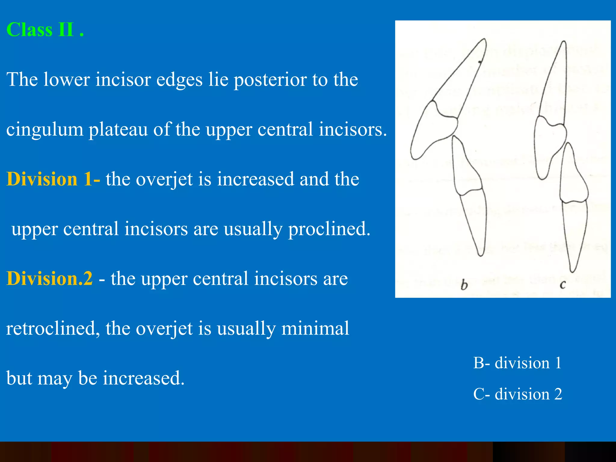 Class II .
The lower incisor edges lie posterior to the
cingulum plateau of the upper central incisors.
Division 1- the overjet is increased and the
upper central incisors are usually proclined.
Division.2 - the upper central incisors are
retroclined, the overjet is usually minimal
but may be increased.
B- division 1
C- division 2
 