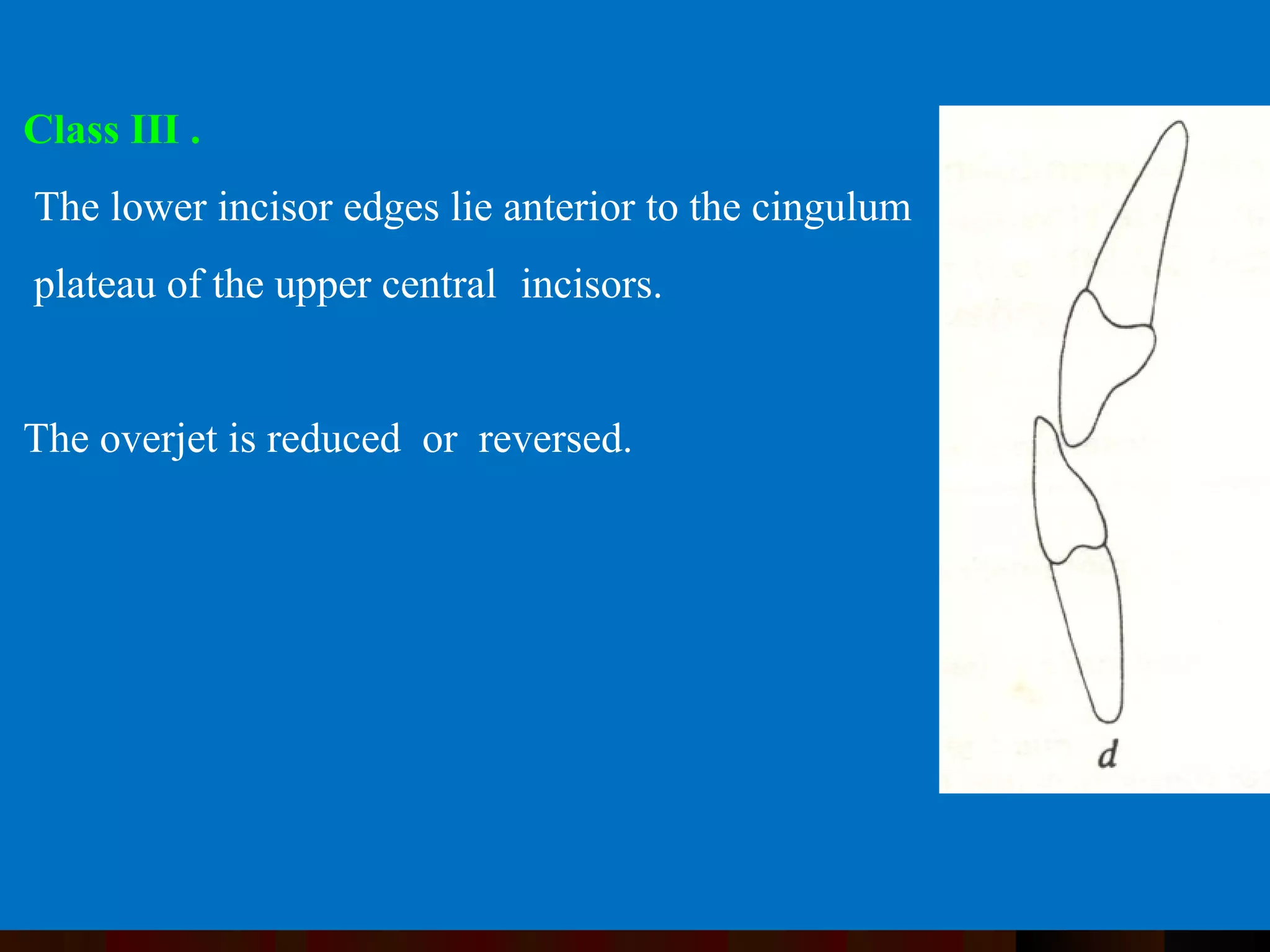 Class III .
The lower incisor edges lie anterior to the cingulum
plateau of the upper central incisors.
The overjet is reduced or reversed.
 