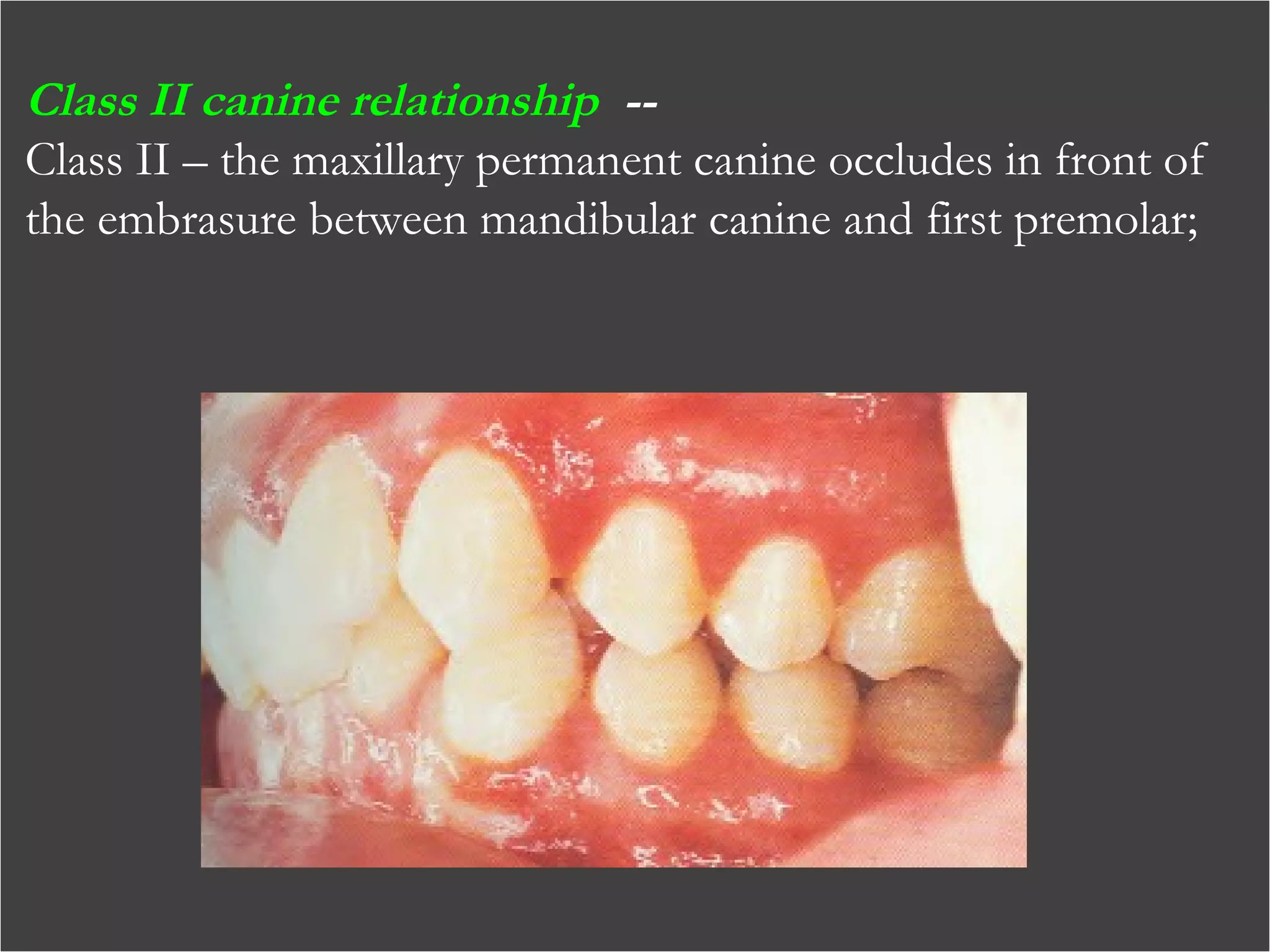 Class II canine relationship --
Class II – the maxillary permanent canine occludes in front of
the embrasure between mandibular canine and first premolar;
 