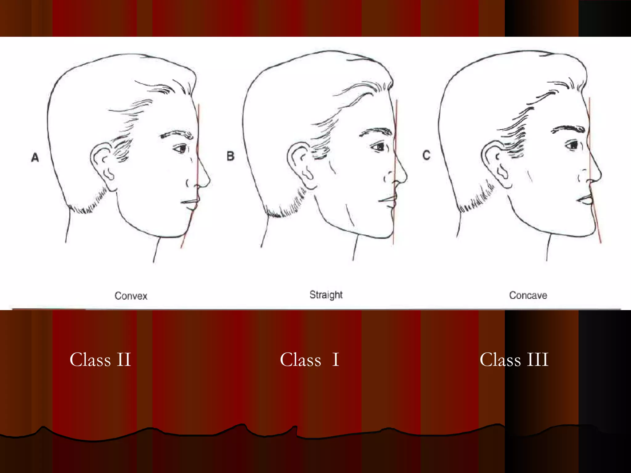 Class II Class I Class III
 