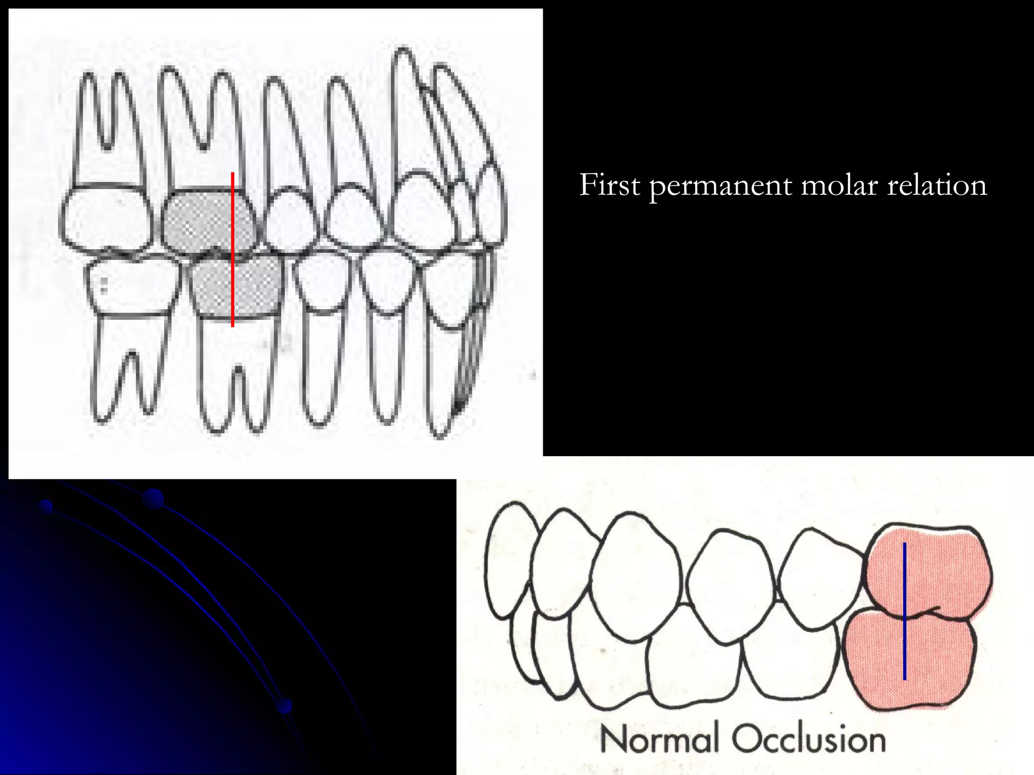 First permanent molar relation
 