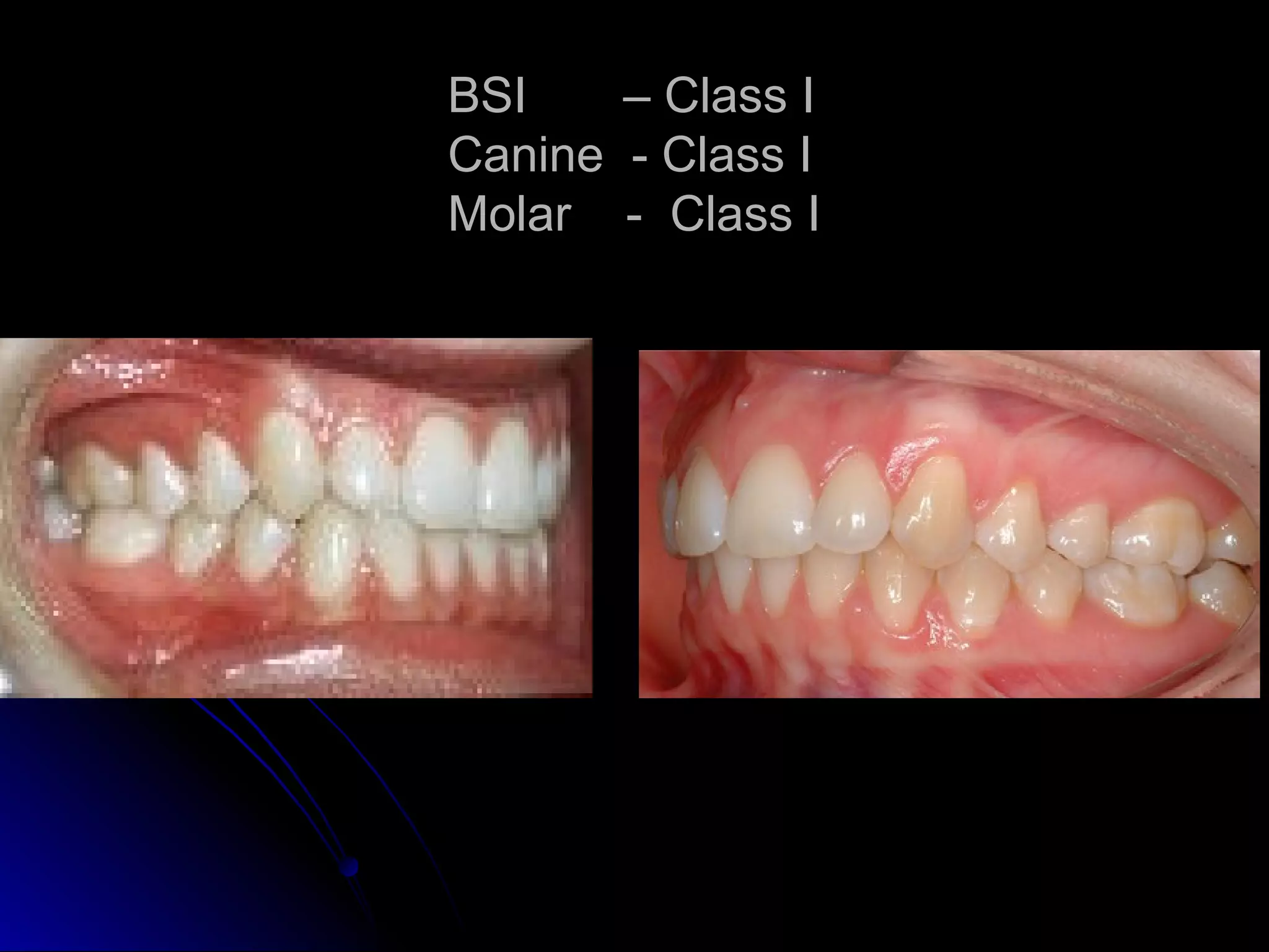 BSI – Class I
Canine - Class I
Molar - Class I
 
