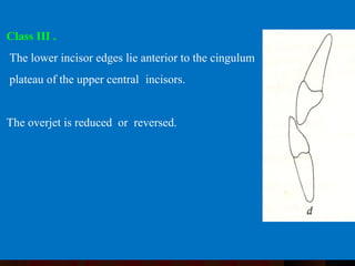 CLASSIFICATION OF NORMAL OCCLUSION AND MALOCCLUSION. | PPT