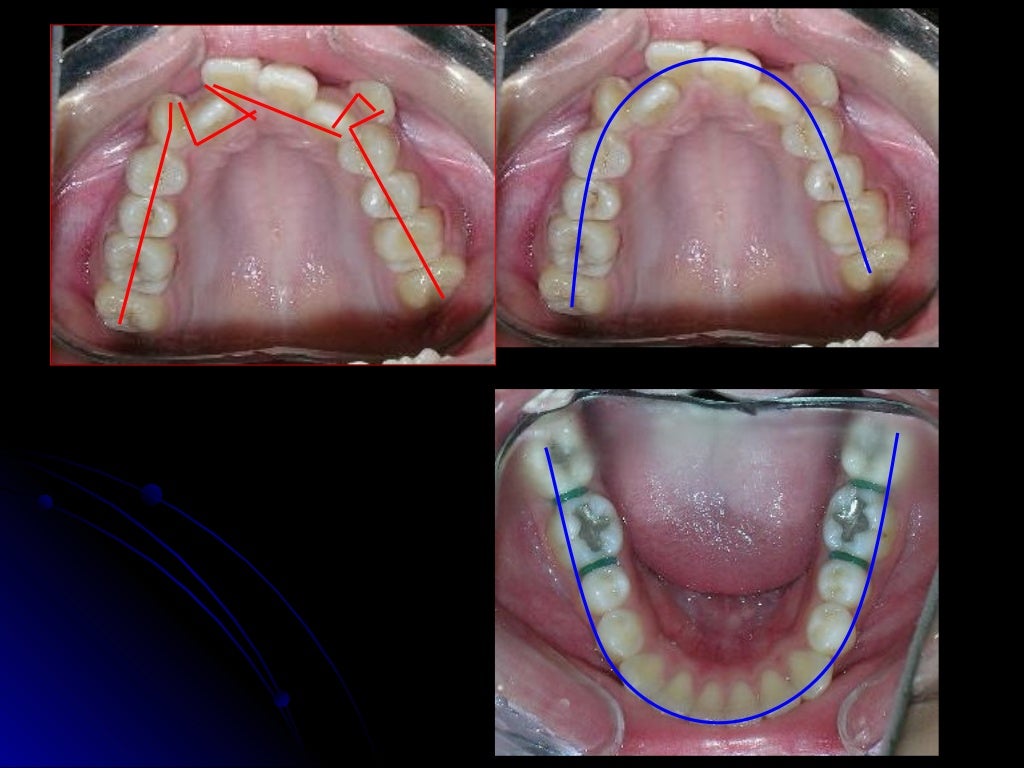 CLASSIFICATION OF NORMAL OCCLUSION AND MALOCCLUSION.