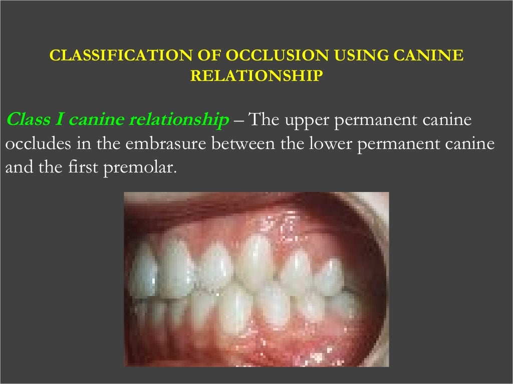 Malocclusion definition in orthodontics image