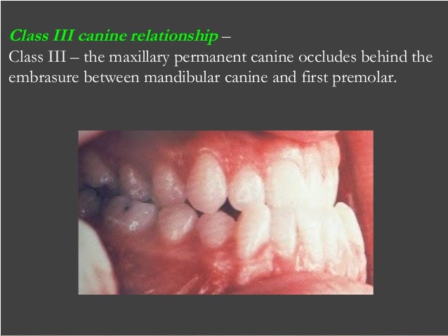 How to prevent malocclusion image