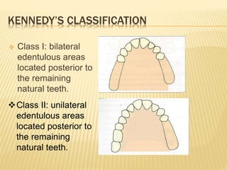 Introduction & classification of removable partial denture | PPTX
