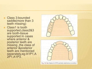 Tooth Case Classification Introduction & classification of removable partial denture | PPTX
