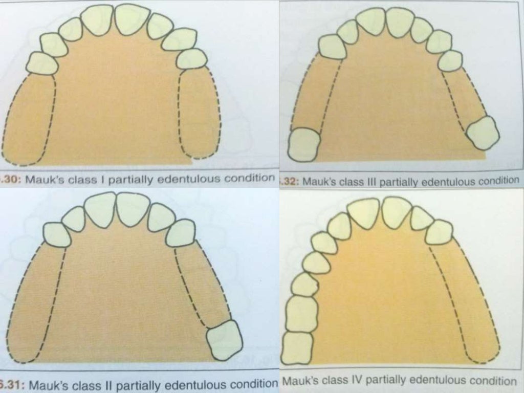 Introduction & classification of removable partial denture