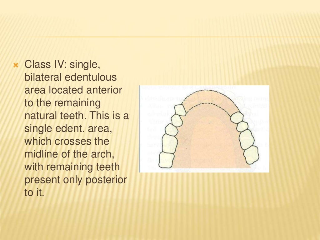 Introduction & classification of removable partial denture
