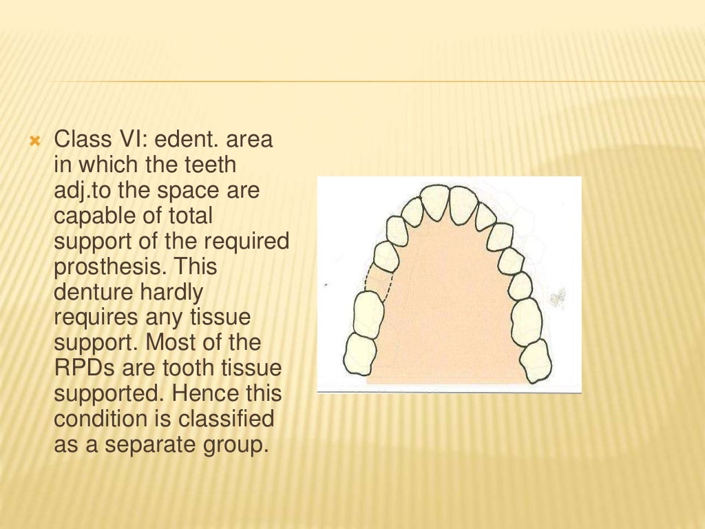 Introduction & classification of removable partial denture