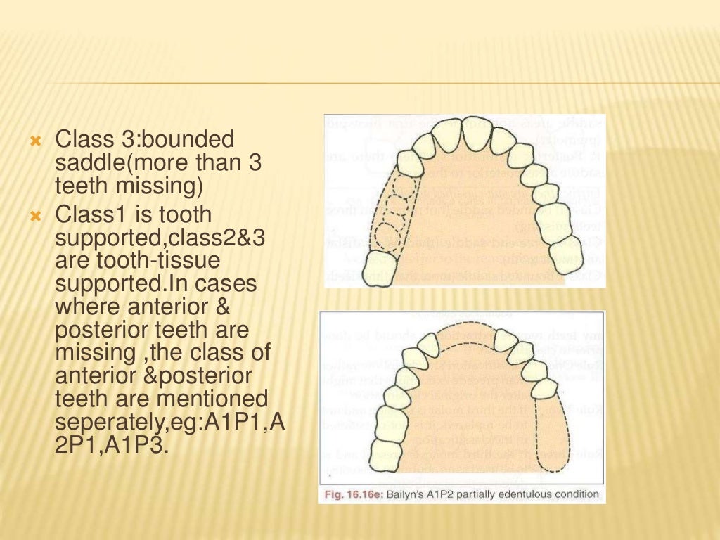 Introduction & classification of removable partial denture