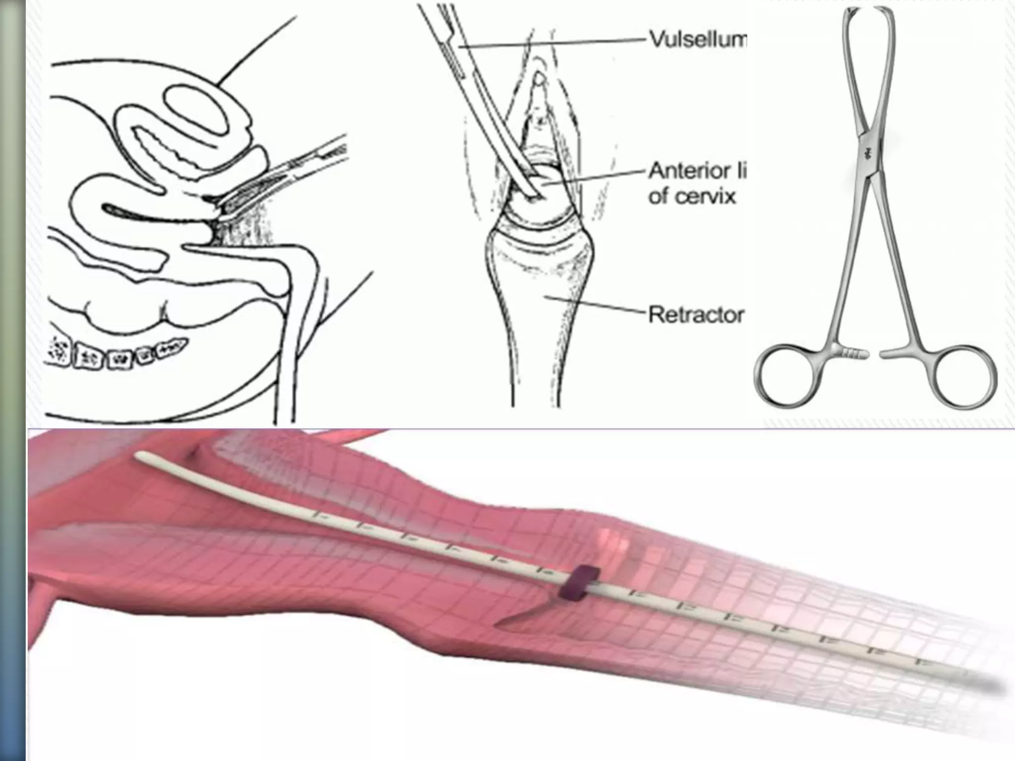 Introduction,dilataion and curretage&suction curetage | PPTX
