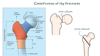 Classification of Hip Fractures
 