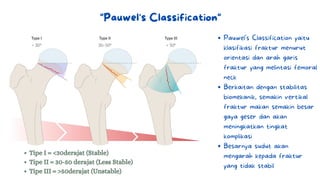 "Pauwel's Classification"
Tipe I = <30derajat (Stable)
Tipe II = 30-50 derajat (Less Stable)
Tipe III = >50derajat (Unstable)
Pauwel's Classification yaitu
klasifikasi fraktur menurut
orientasi dan arah garis
fraktur yang melintasi femoral
neck
Berkaitan dengan stabilitas
biomekanik, semakin vertikal
fraktur makan semakin besar
gaya geser dan akan
meningkatkan tingkat
komplikasi
Besarnya sudut akan
mengarah kepada fraktur
yang tidak stabil
 