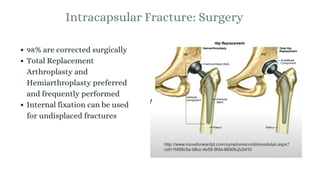 Intracapsular Fracture: Surgery
98% are corrected surgically
Total Replacement
Arthroplasty and
Hemiarthroplasty preferred
and frequently performed
Internal fixation can be used
for undisplaced fractures
 