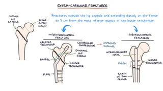 Fractures outside the hip capsule and extending distally on the femur
to 5 cm from the most inferior aspect of the lesser trochanter
 