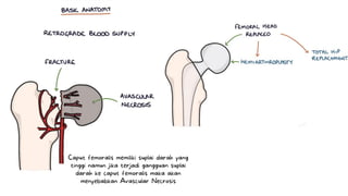 Caput femoralis memiliki suplai darah yang
tinggi namun jika terjadi gangguan suplai
darah ke caput femoralis maka akan
menyebabkan Avascular Necrosis
 
